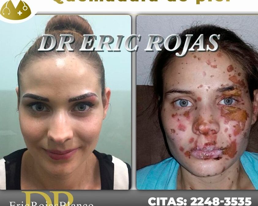 olucionamos una quemadura de piel en nuestra paciente