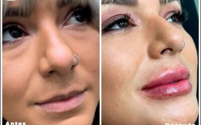 Mira los resultados de nuestra paciente que se realizó relleno de labios.