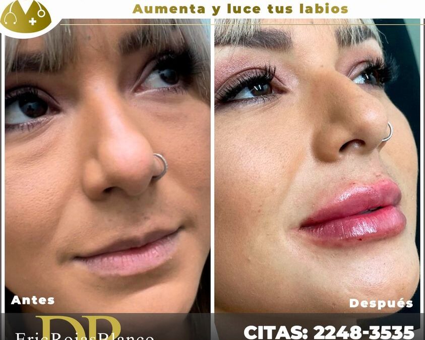 Mira los resultados de nuestra paciente que se realizó relleno de labios.