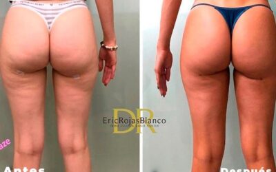 Elimina la celulitis con nuestro súper láser, no esperes más.