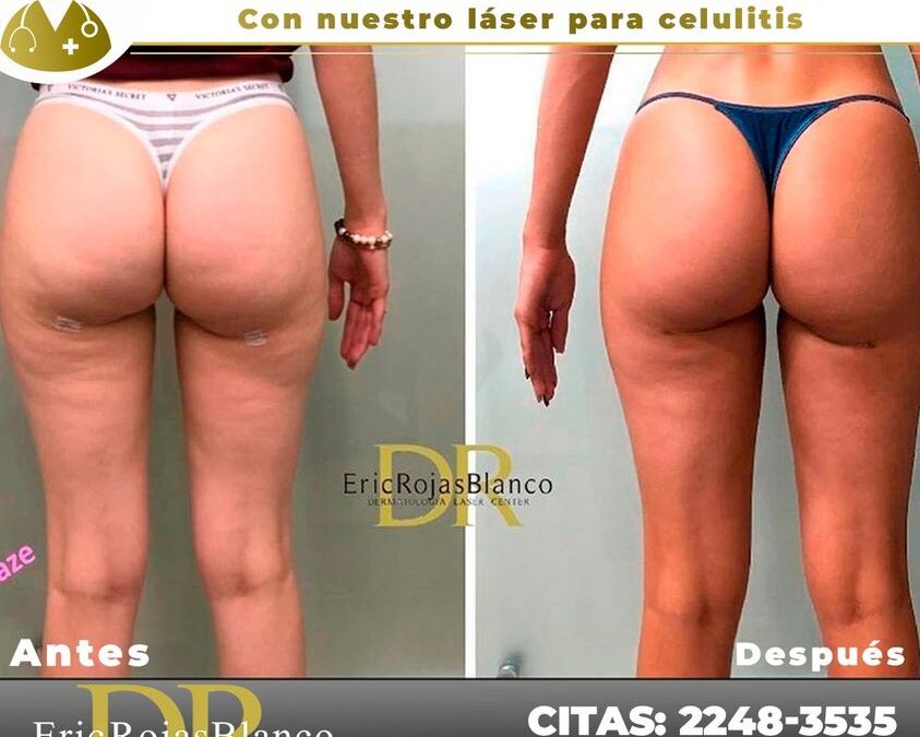 Elimina la celulitis con nuestro súper láser, no esperes más.