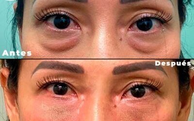 Elimina las bolsas de tus ojos y luce un rostro más joven, mira que increíbles resultados.