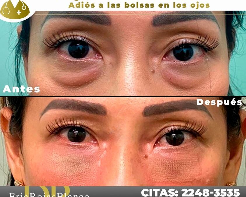 Elimina las bolsas de tus ojos y luce un rostro más joven, mira que increíbles resultados.