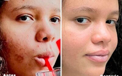 Elimina el acné de tu rostro con nuestro increíble tratamiento