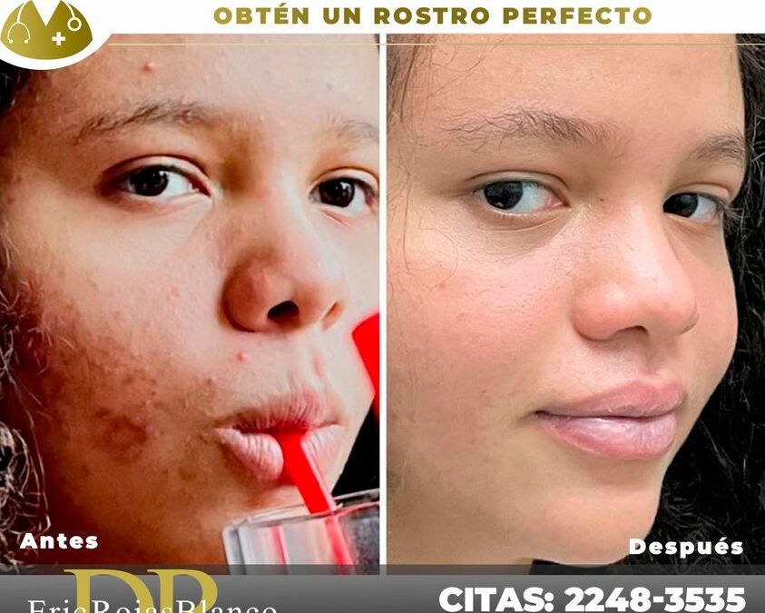 Elimina el acné de tu rostro con nuestro increíble tratamiento
