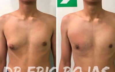 NO te acomplejes más por la ginecomastia, ven para brindarte una solución