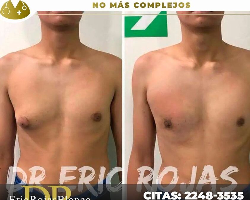 NO te acomplejes más por la ginecomastia, ven para brindarte una solución