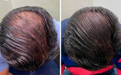 Recupera tu cabello