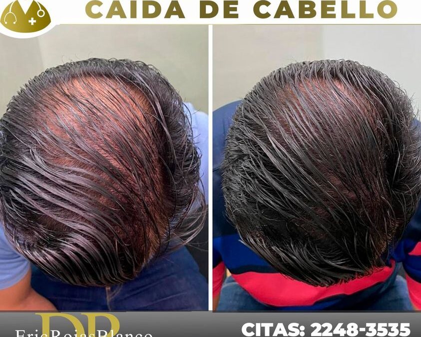 Recupera tu cabello