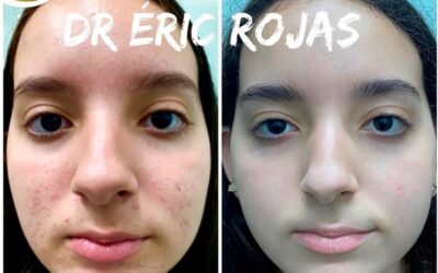 Mira los increíbles resultados de nuestro tratamiento de acné, ¿Qué te pareció el cambio?