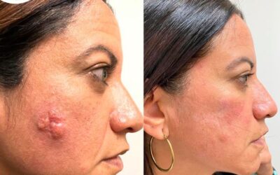 Eliminación de cáncer de piel. Mira este súper resultado.