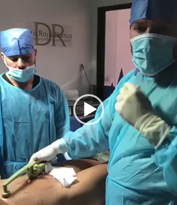 Tenemos lo último en reafirmación de piel para mejorar  la flacides de la piel en un gran porcentaje.