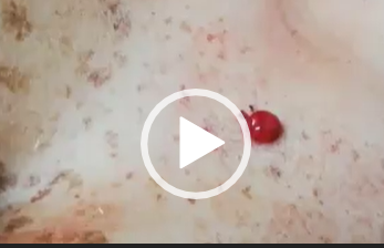 NEVUS RUBÍ