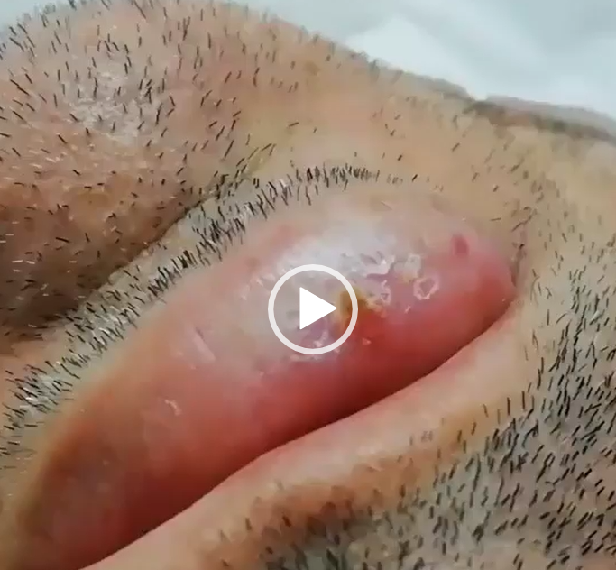 Carcinoma Epidermoide de Labio.