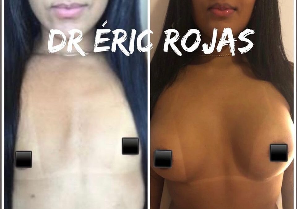 Aumento mamario. 🤩