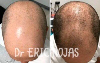 ¡Aún tienes tiempo!, recupera tu cabello.🤩👇