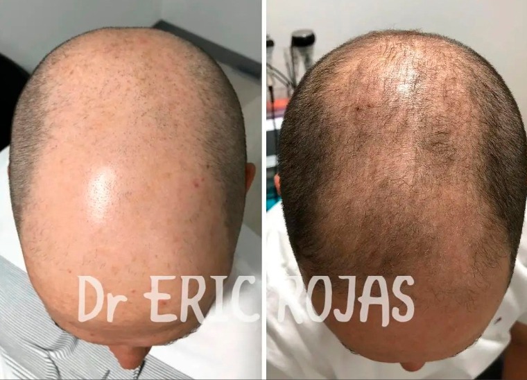 ¡Aún tienes tiempo!, recupera tu cabello.🤩👇