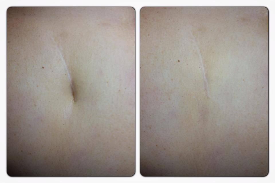 Elimina las cicatrices que te acomplejan.