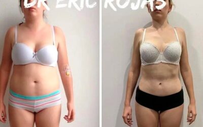 Resultados que puedes obtener con Slim Láser. 🤩👇