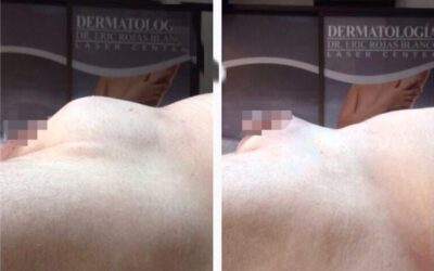 Recordá que el Slim Láser en Pubis está en descuento.