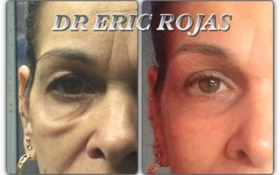 Elimina tus ojeras, mejora tu rostro.