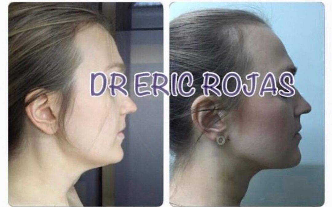 Mira la increíble diferencia entre un brazo tratado con Slim Láser y uno que no.