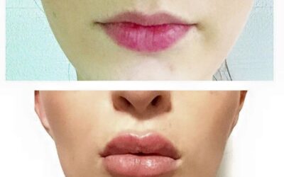 Los mejores cambios en tus labios los puedes tener con el relleno de Labios