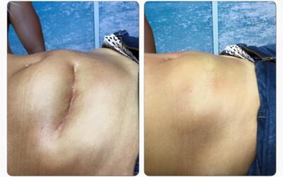 Solución de cicatriz en abdomen