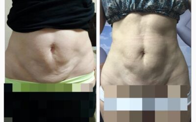 Esa piel sobrante en tu abdomen podemos retraerla con nuestro nuevo láser FOTONA.