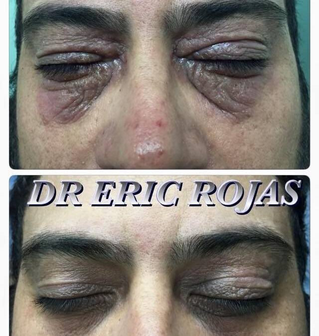 Nuestra paciente tenía un año de tener sus párpados así, nosotros en una semana logramos solucionar su problema.