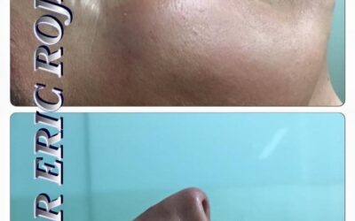 Rinolift es el mejor procedimiento para mejorar tu perfil.