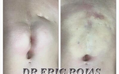 En 5 minutos podemos eliminar la cicatriz que no te gusta de tu abdomen. ¡Visítanos!