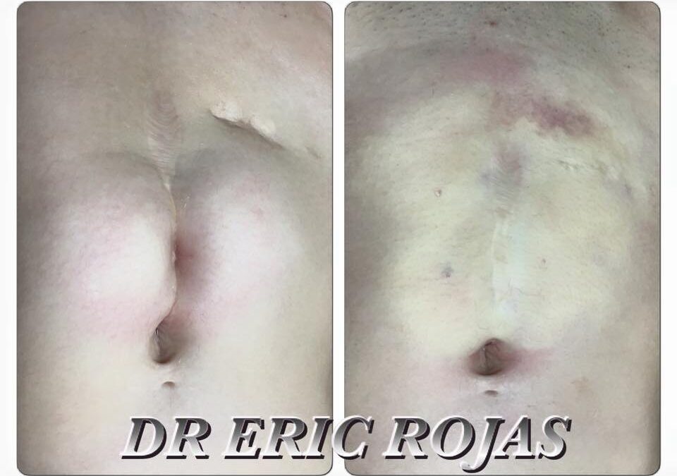 En 5 minutos podemos eliminar la cicatriz que no te gusta de tu abdomen. ¡Visítanos!