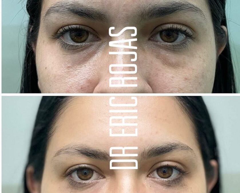 Limpiamos tu rostro.