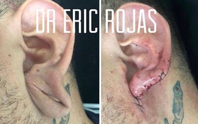 Reconstrucción de oreja.