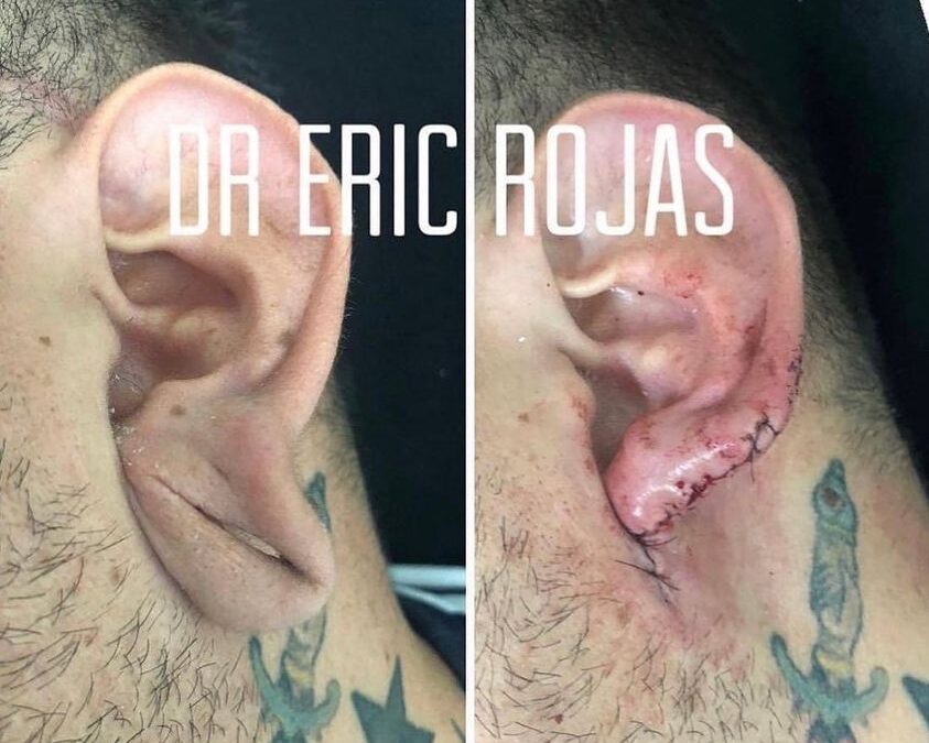 Reconstrucción de oreja.
