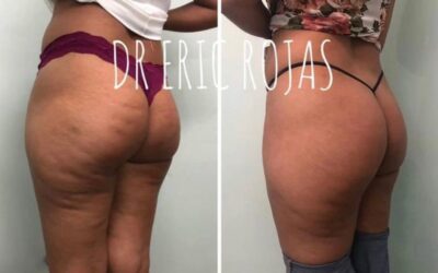 Elimina La celulitis de tu cuerpo.