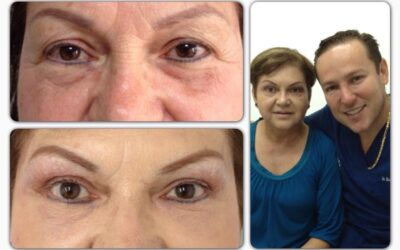 Rejuvenecimiento facial, luce increíble.