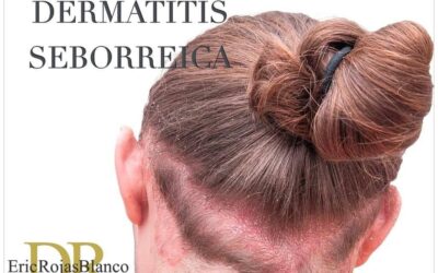 s la inflamación de regiones de la piel que tienen una alta densidad de glándulas sebáceas.