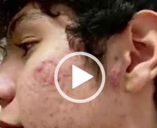 Limpia y sana tu rostro del acné con el mejor tratamiento.