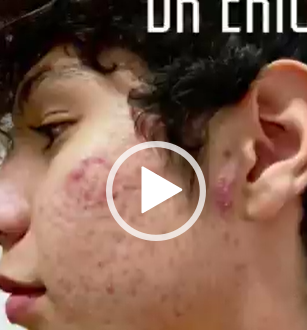 Limpia y sana tu rostro del acné con el mejor tratamiento.