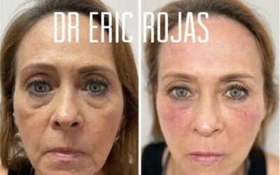 Rejuvenecimiento facial, reduce años a tu rostro.