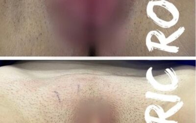 Dermo-Labioplastía vaginal.
