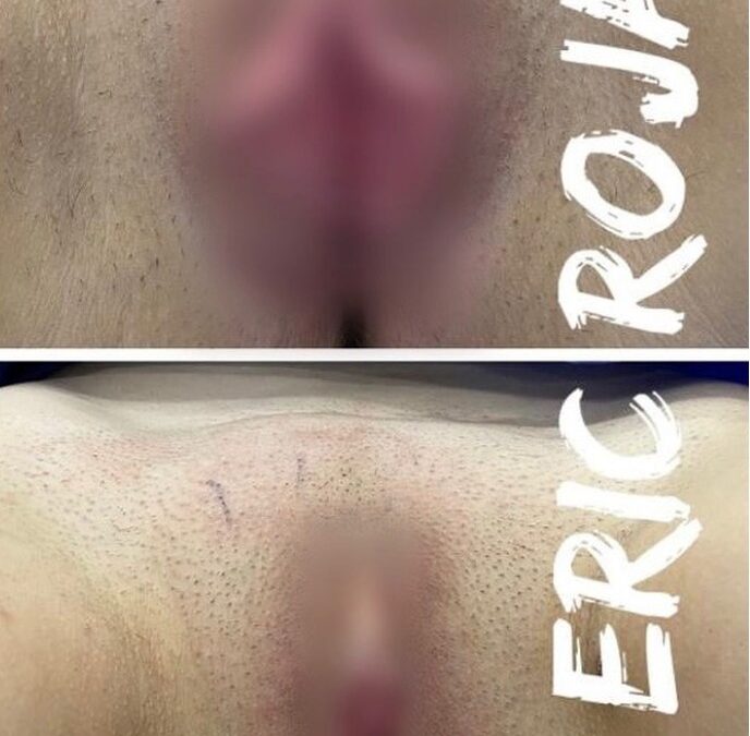 Dermo-Labioplastía vaginal.