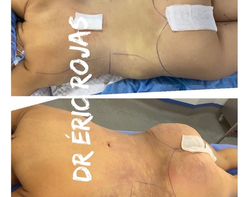 Increíble cambio logrado con Slim Láser.