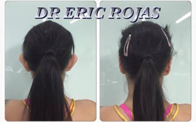 La dermo-otoplastia es lo mejor para corregir tus orejas. Precio especial este mes.