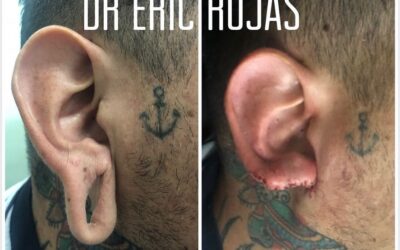 Corrección de orejas DR ERIC ROJAS 22483535