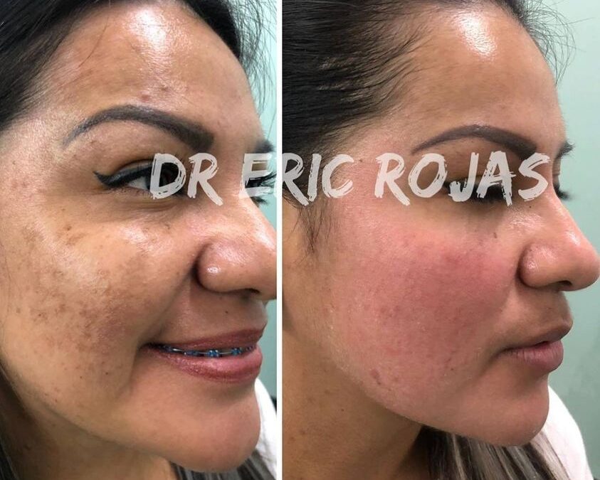 Elimina las manchas de tu rostro.