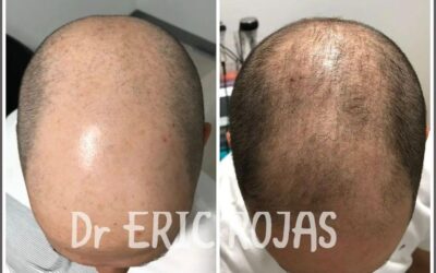 Tenemos el mejor tratamiento para la alopecia.