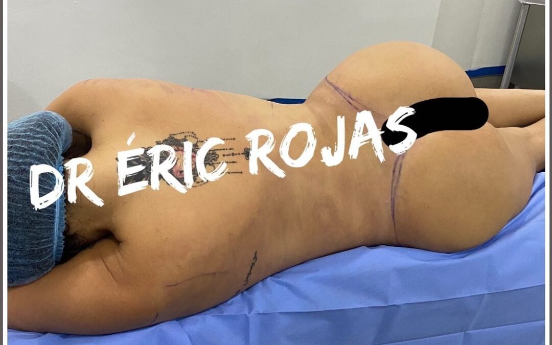 Cuerpos moldeados con Slim Láser.